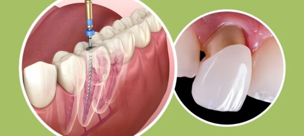 root canal treatment