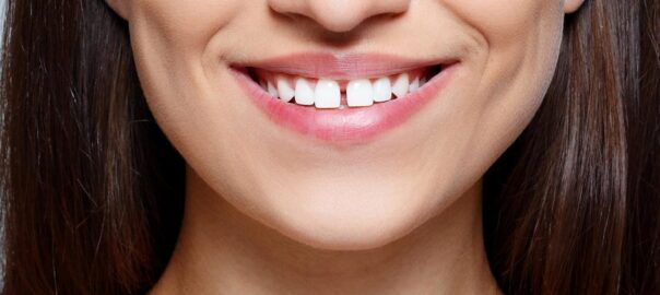 gaps in teeth